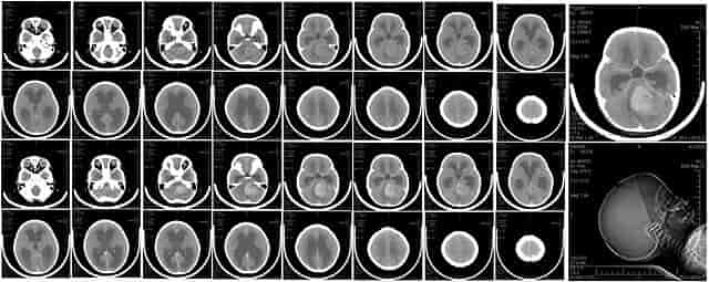 CT-scanning af hjerne 