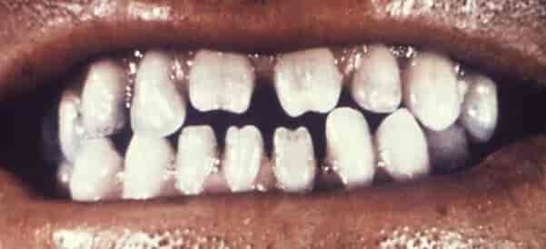 Huthinsons tænder