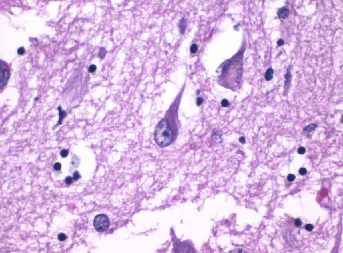 Histopatologi af neurofibrillære knuder (tangles) inde i nervecellerne.