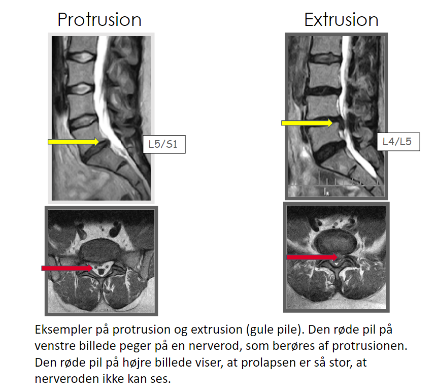 Fra artiklen Back pain was less explained than leg pain: a cross-sectional study using magnetic resonance imaging in low back pain patients with and without radiculopathy, BMC Musculoskeletal Disorders (2015)