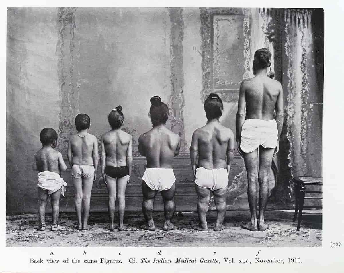 Fem personer med forskellige former for nanisme og en person uden (til højre). Fra et indisk medicinsk tidsskrift The Indian Medical Gazette, 1910.