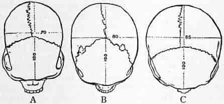 Illustrering af antropometri. Til venstre ses et eksempel på et langskallet kranium og til højre ses et kortskallet kranium.