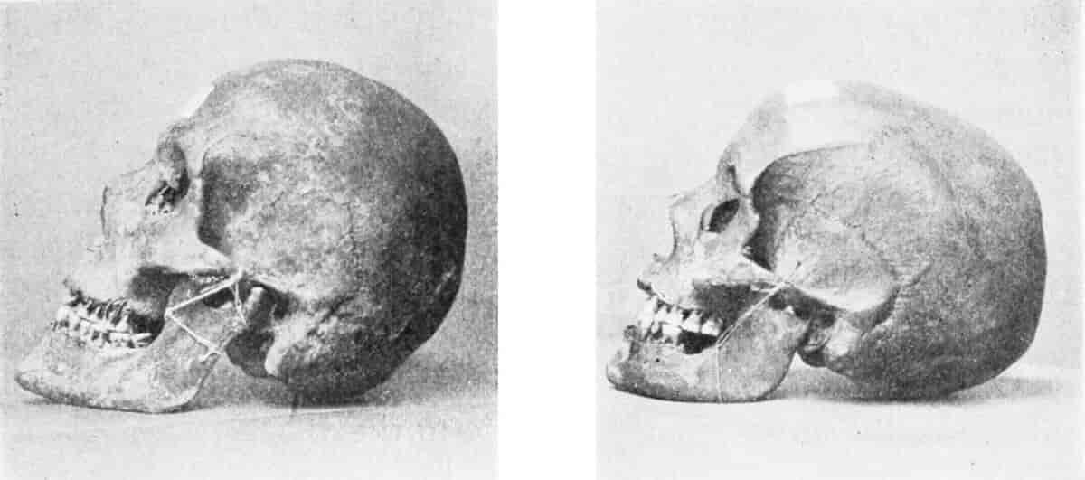 Til venstre ses et kortskallet kranium (brachykefal) og et højre et langskallet kranium (dolikocephal). 