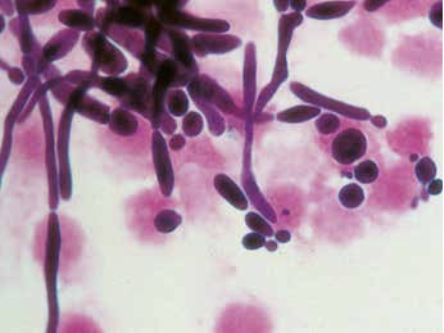 Candida albicans fra væske fra bughulen